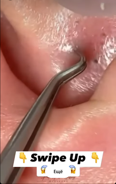Best 15 Tips For Squeezing Blackheads On Nose