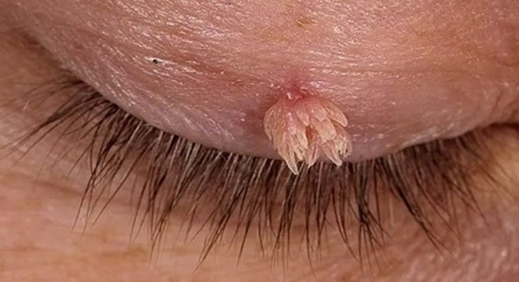Notice These Skin Tags on Your Neck or Underarms? Don’t Ignore Them – Details in the First Comment!