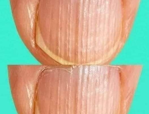 Rippled Nails? This Subtle Sign Could Point to an Underlying Condition